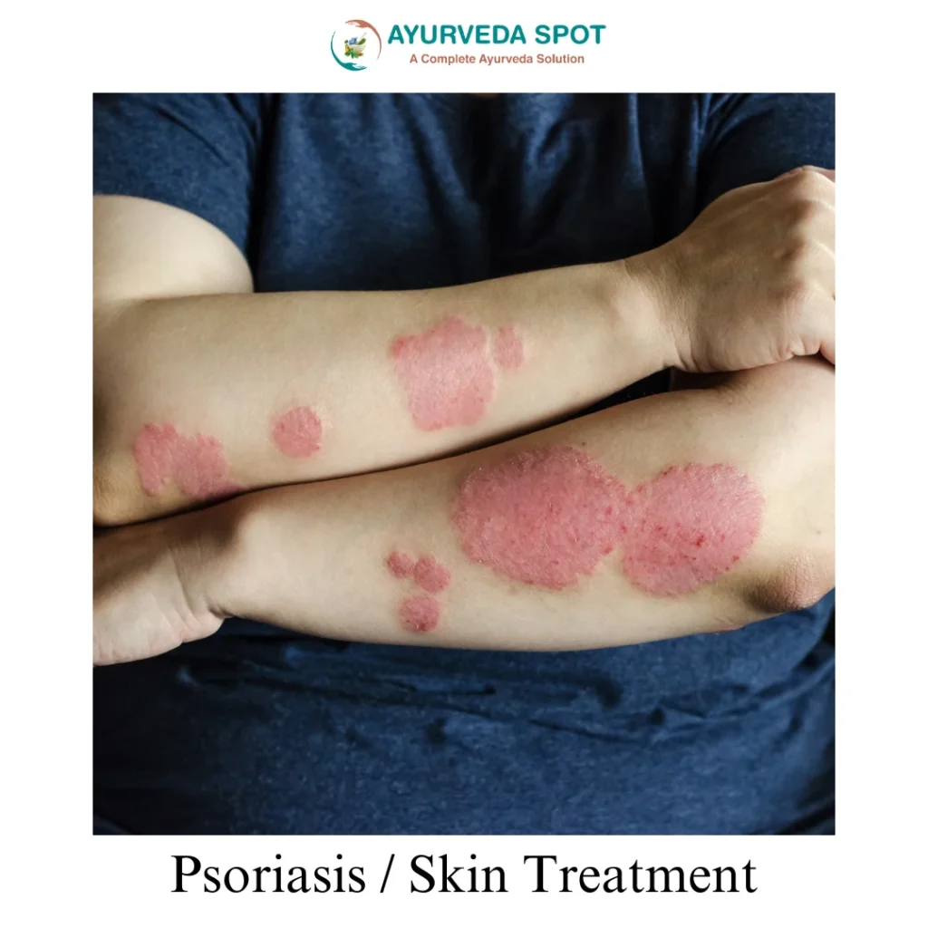 Psoriasis / Skin Treatment